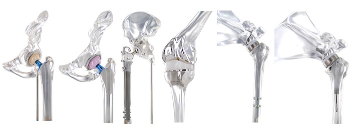 orthopedic-implants